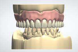 FULL DENTURE DESIGN